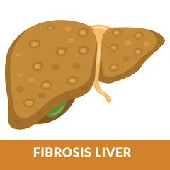Illustration of Liver Disease Fibrosis