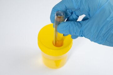 Gloved Hand Holding Urine Sample Container for Laboratory Analysis