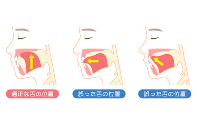適正な舌の位置と誤った舌の位置　ミューイング © koti
