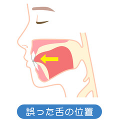 誤った舌の位置　下がっている舌の位置