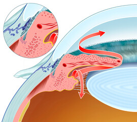 Schematic representation of glaucoma. A progressive eye disease that damages the optic nerve, usually due to elevated intraocular pressure, causing irreversible vision loss.