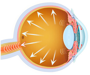 Illustration of the eyeball with glaucoma. A progressive disease that damages the optic nerve, usually due to elevated intraocular pressure, causing irreversible vision loss.