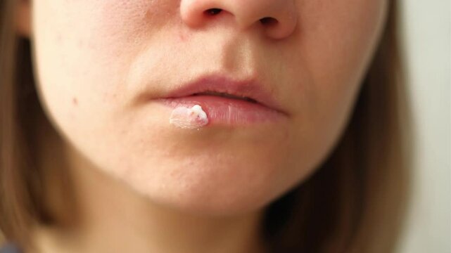 Close-up of a woman's face with herpes on her lips