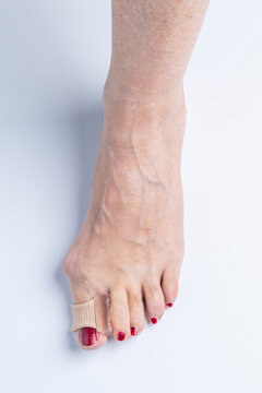Silicone separator with elastic ring, inserted between the big toe and the index finger of a foot with hallux valgus