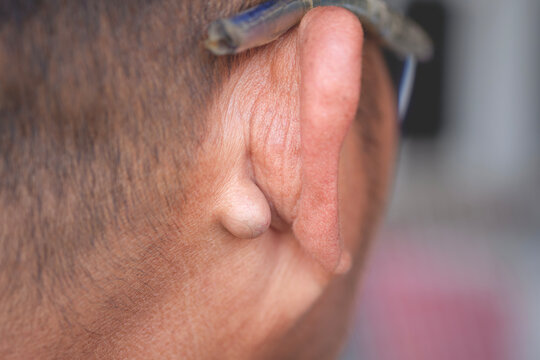 A large sebaceous cyst lump on base behind the external ear of middle aged man. close up with copy space