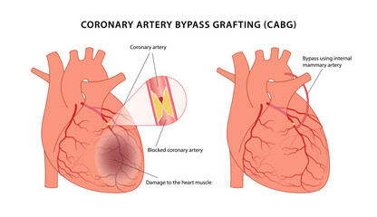 Coronary artery bypass grafting (CABG). Medical illustration of bypass surgery of a diseased heart using the internal mammary artery. Vector illustration in a flat style