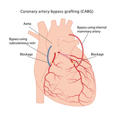 Coronary artery bypass grafting (CABG). Medical illustration of bypass surgery of a diseased heart using the internal mammary artery and the vein of the lower leg. Vector illustration in a flat style