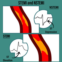 STEMI vs. NSTEMI Comparative Visual Guide: Complete vs. Partial Coronary Artery Blockage with ST-Elevation, Depression - Dual-Pathology Medical Illustration for Cardiology Education