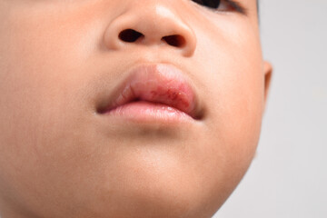 Close up of Injured Asian boy with swollen and bleeding mouth
