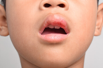 Close up of Injured Asian boy with swollen and bleeding mouth