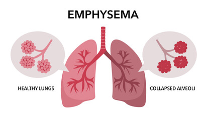 Obraz premium Emphysema disease concept. Damaged alveoli, failure airway. Floppy walls between air sacs in human lungs. Shortness of breath, chest tightness. Illness of respiratory system flat vector illustration