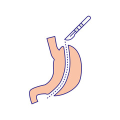 Gastrectomy illustration