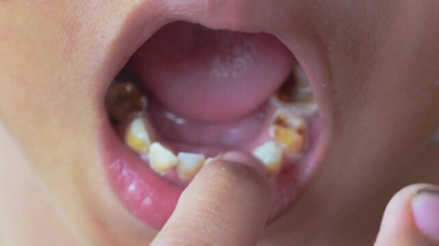 Slow motion. Close-up of a child wiggling his front milk teeth. A boy aged 6-7 years experienced loose front teeth, permanent tooth replacement, dentistry.