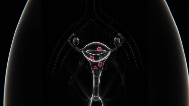 Uterine Fibroids Indication X-ray in close up HD video | Uterine Fibroids of female X-ray video in HD