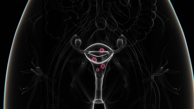 Uterine Fibroids Indication X-ray in close up HQ video | Uterine Fibroids of female X-ray video in HQ