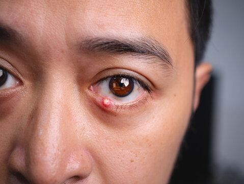 Close Up of Adult Man with one eye infection, Chalazion, Stye (hordeolum) on eyelid.