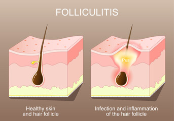 Obraz premium Folliculitis. Healthy skin before and after Infection and inflammation of the hair follicle. Acne