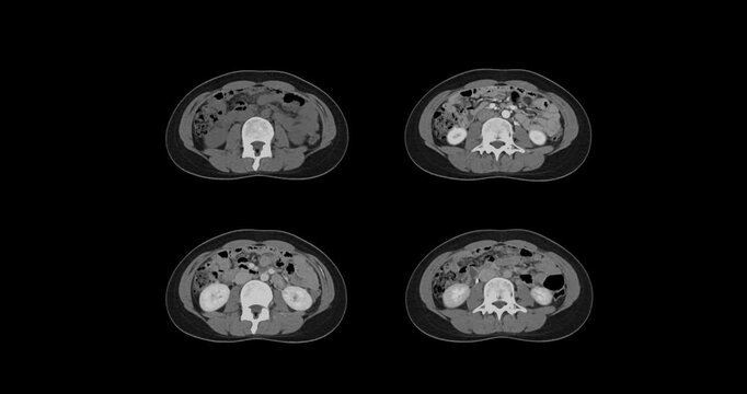 CT whole abdomen normal study: No abnormalities detected. All organs appear within normal limits with no signs of pathology.