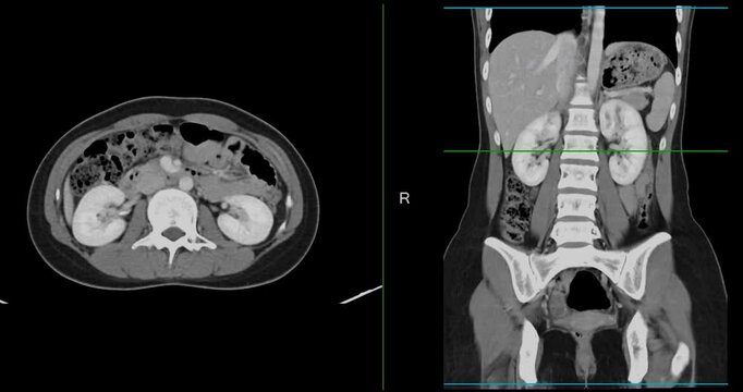 CT whole abdomen normal study: No abnormalities detected. All organs appear within normal limits with no signs of pathology.