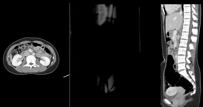 CT whole abdomen normal study: No abnormalities detected. All organs appear within normal limits with no signs of pathology.