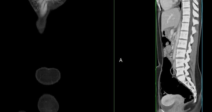 CT whole abdomen normal study: No abnormalities detected. All organs appear within normal limits with no signs of pathology.