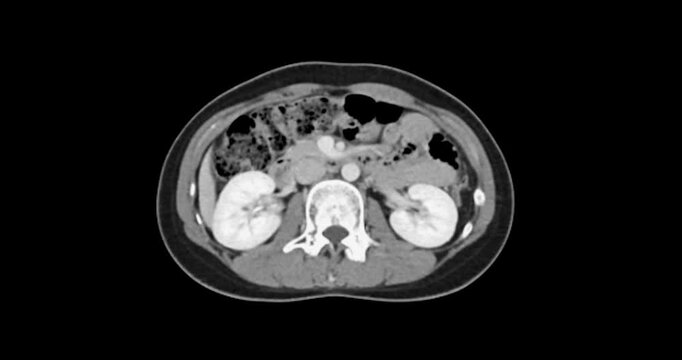 CT whole abdomen normal study: No abnormalities detected. All organs appear within normal limits with no signs of pathology.