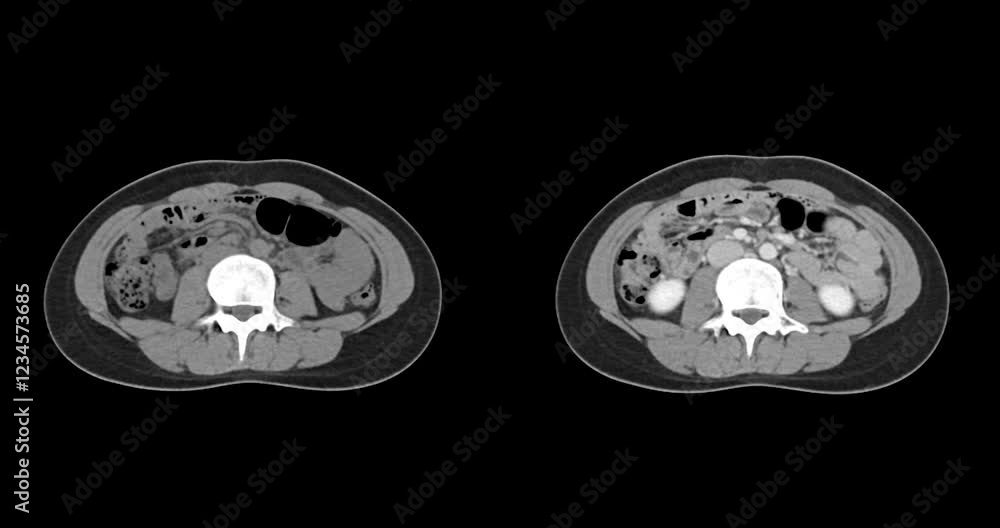 Poster ct whole abdomen normal study: no abnormalities detected. all organs appear within normal limits wit