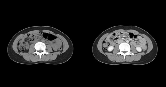 CT whole abdomen normal study: No abnormalities detected. All organs appear within normal limits with no signs of pathology.