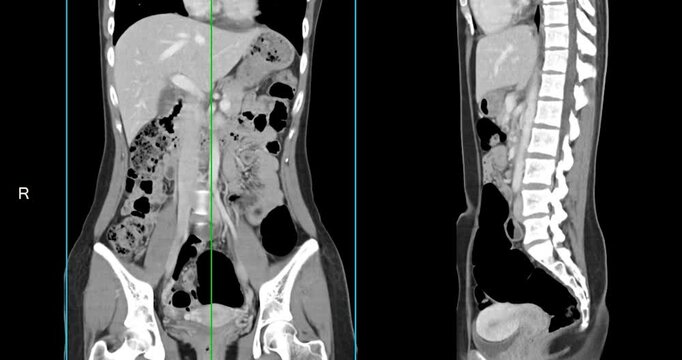 CT whole abdomen normal study: No abnormalities detected. All organs appear within normal limits with no signs of pathology.