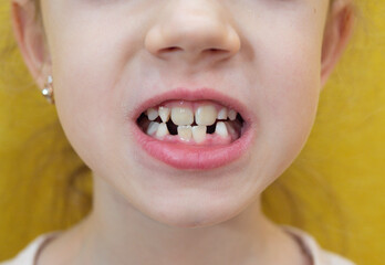 Detailed view of a child's open mouth, showcasing the transition from baby teeth to permanent teeth...