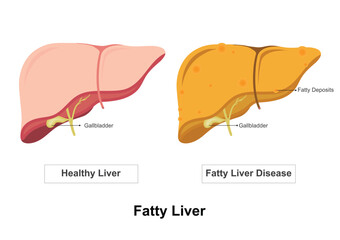 Normal Liver And Fatty Liver Disease.