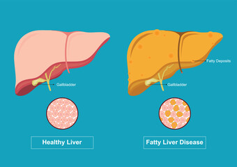 Healthy liver and Fatty liver isolated on white.