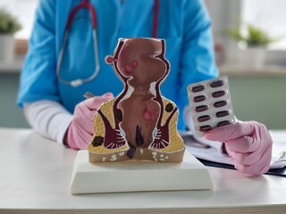 Doctor holds model of rectum with two packs of pills. Treatment of hemorrhoids