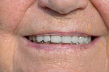 Obraz premium Elderly Smile with Dental Work