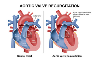 Aortic Valve Regurgitation Heart Disease Illustration