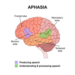 Aphasia language disorder brain illustration