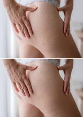 A before-and-after comparison of a woman's thigh, showing the reduction of stretch marks. The first...