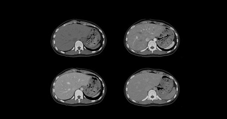 Contrast-enhanced CT whole abdomen study revealing normal anatomical structures, with no signs of pathology or abnormal fluid accumulation.