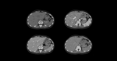 Contrast-enhanced CT whole abdomen study revealing normal anatomical structures, with no signs of pathology or abnormal fluid accumulation.