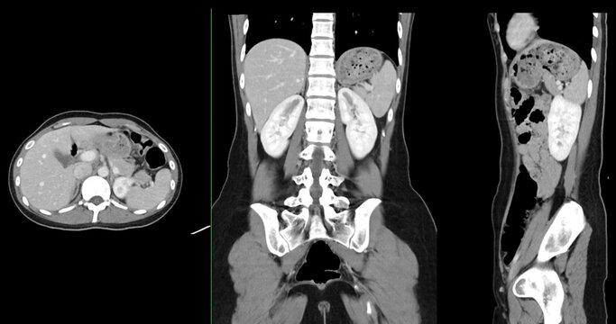 Contrast-enhanced CT whole abdomen study revealing normal anatomical structures, with no signs of pathology or abnormal fluid accumulation.