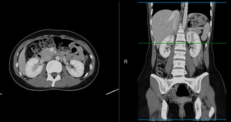 Contrast-enhanced CT whole abdomen study revealing normal anatomical structures, with no signs of pathology or abnormal fluid accumulation.