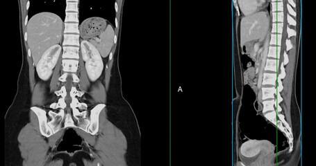 Contrast-enhanced CT whole abdomen study revealing normal anatomical structures, with no signs of...