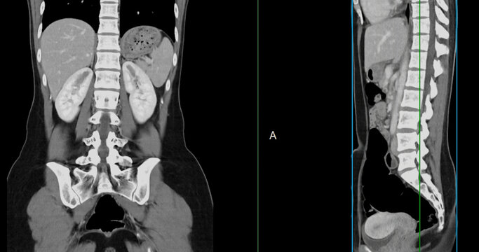 Contrast-enhanced CT whole abdomen study revealing normal anatomical structures, with no signs of pathology or abnormal fluid accumulation.