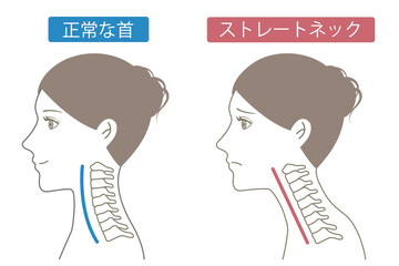 ストレートネック　ビフォアアフター