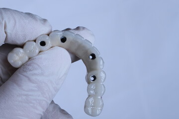 Dental implant supported full arch porcelain dental prosthesis for edentulous jaws in dentistry. Intraosseous dental implant and full arch dental prosthesis treatment. smile makeover. © UniqDream