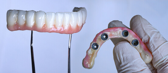 Dental implant supported full arch porcelain dental prosthesis for edentulous jaws in dentistry. Intraosseous dental implant and full arch dental prosthesis treatment. smile makeover. © UniqDream