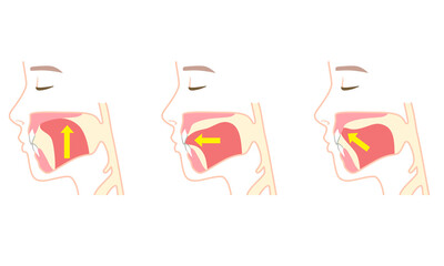 適正な舌の位置と誤った舌の位置　ミューイング