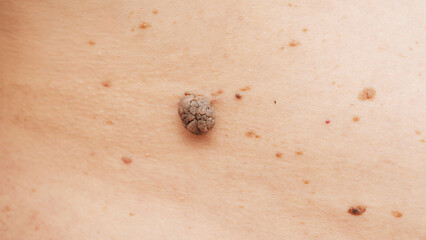 Moles and birthmarks on human skin close-up.