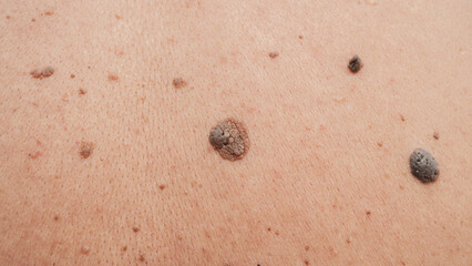 Moles and birthmarks on human skin close-up.