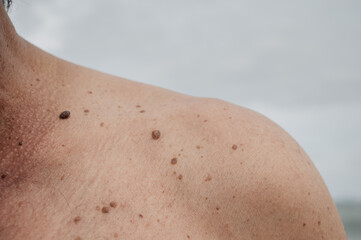Skin texture black birthmarks and moles on the skin of an elderly man